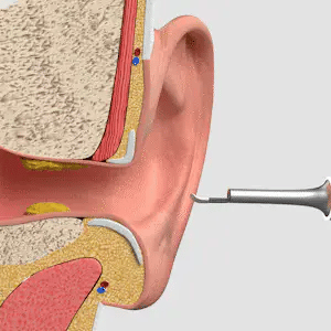 6PCS Stainless Steel Ear Wax Removal Kit for Ear Care Cleaning